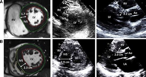 mildly increased septal wall thickness